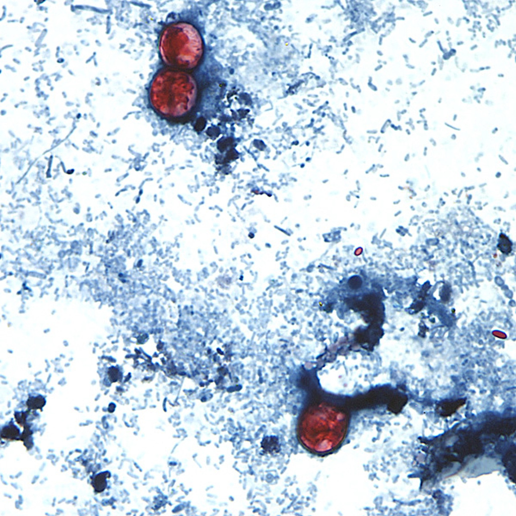 Cases of Cyclosporiasis in the Granite State more than double Cases of Cyclosporiasis in the Granite State more than double